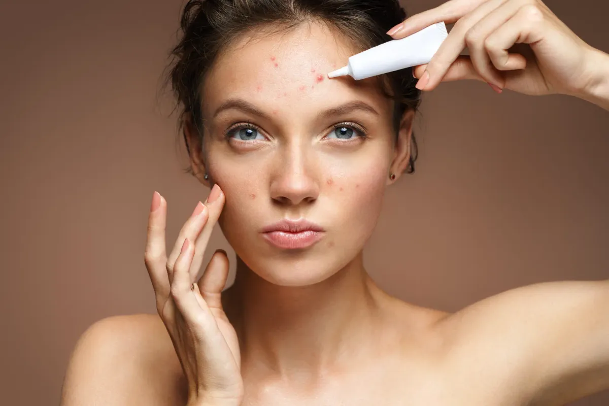 Acne — Dermatologia Clínica na Clínica Mansur em Juiz de Fora