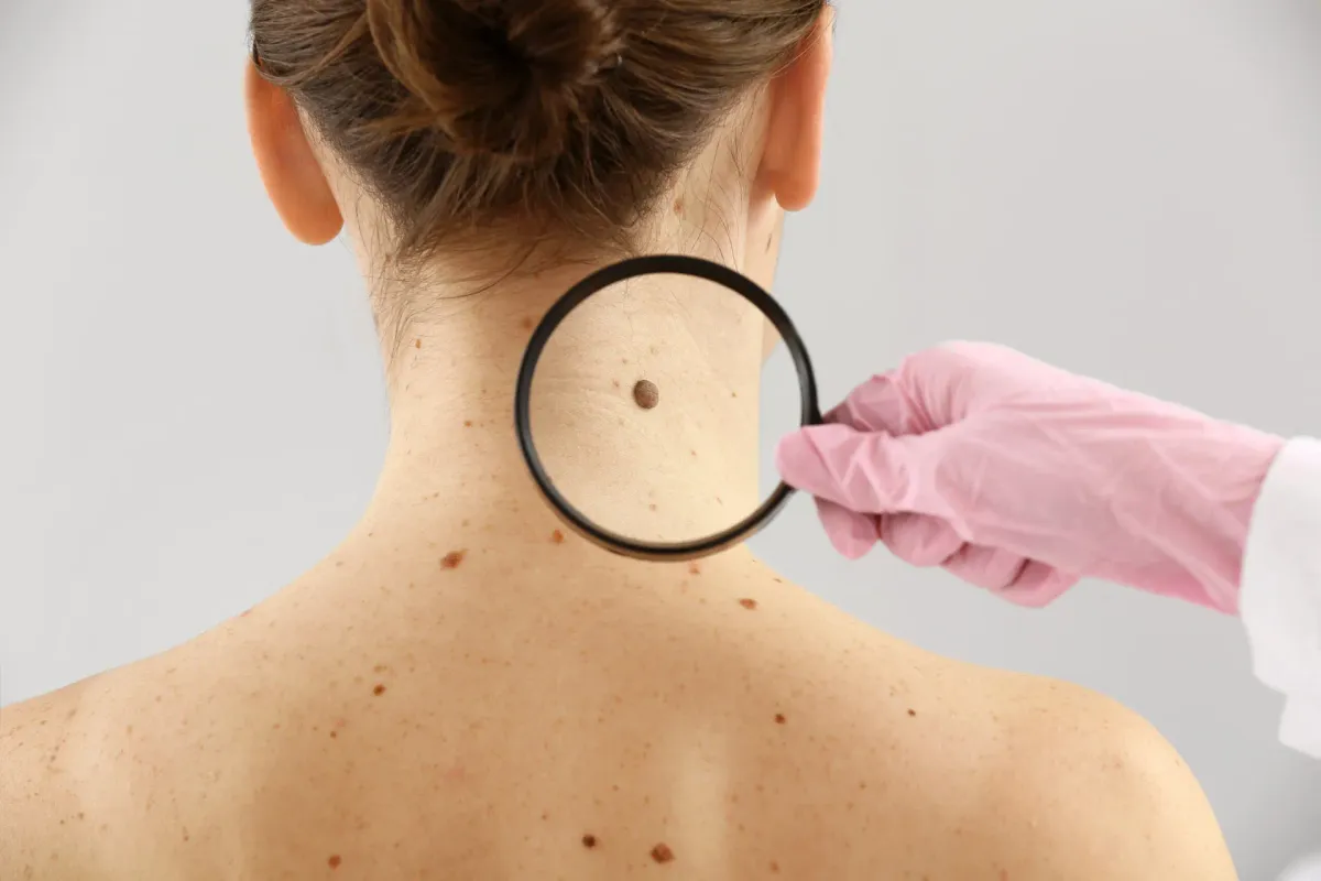 Câncer de Pele — Dermatologia Clínica na Clínica Mansur em Juiz de Fora