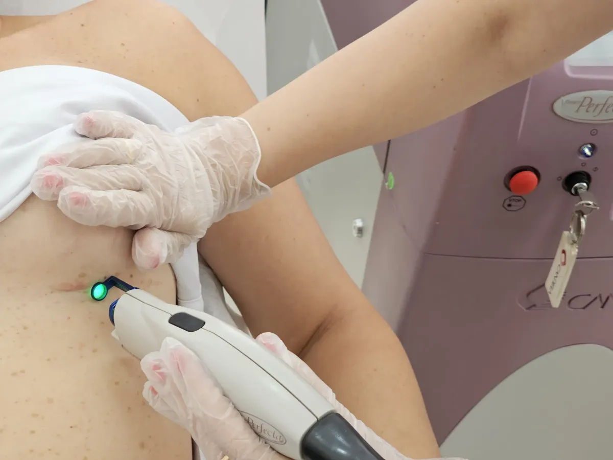 Cicatrizes — Dermatologia Clínica na Clínica Mansur em Juiz de Fora
