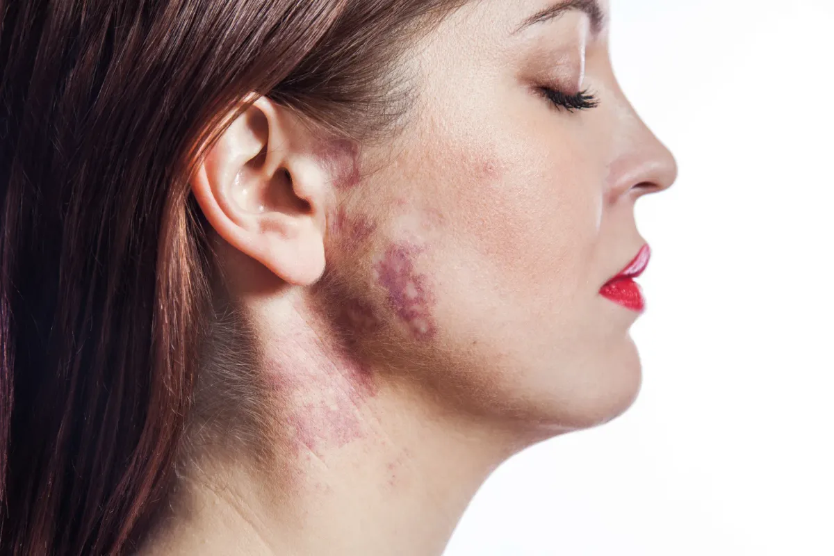 Mancha Vinho do Porto — Dermatologia Clínica na Clínica Mansur em Juiz de Fora