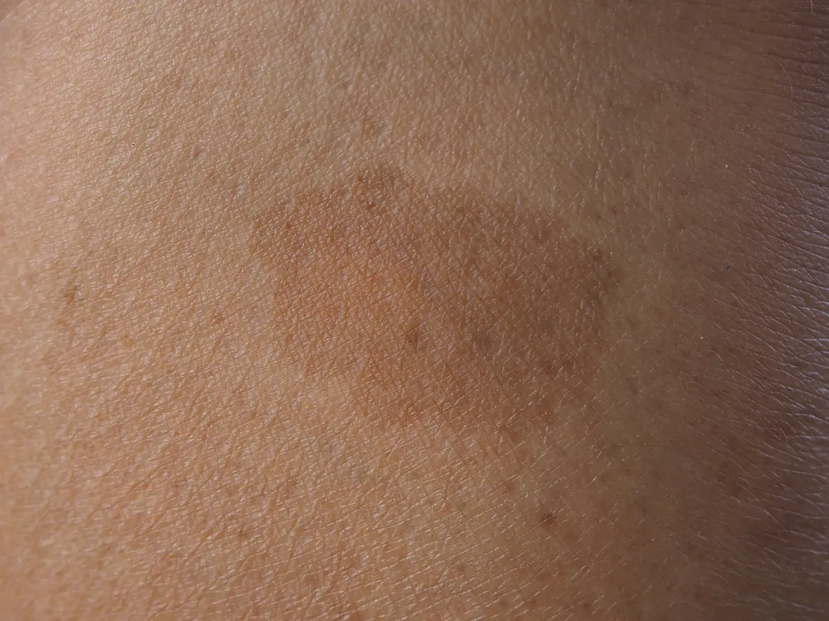 Manchas Escuras e Sardas — Dermatologia Clínica na Clínica Mansur em Juiz de Fora