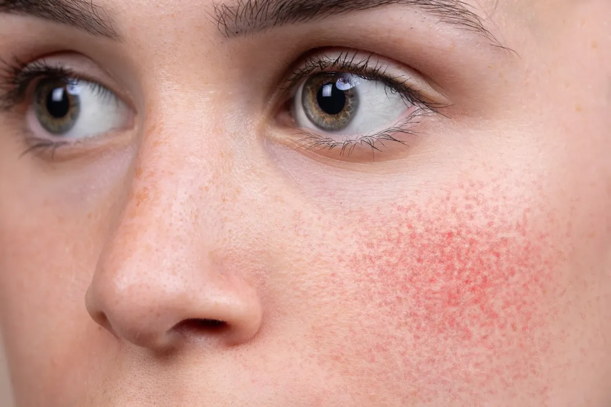 Rosácea — Dermatologia Clínica na Clínica Mansur em Juiz de Fora